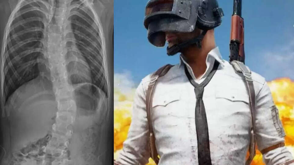 Kyphoscoliosis